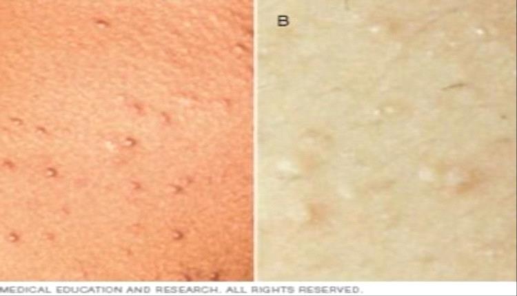 الطفح الجلدي المزمن.. بقع مزعجة قد تعوق الحياة اليومية